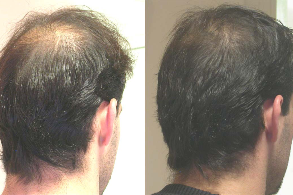 Густота волос мужчин. Мезотерапия для волос до и после мужчины. Мезотерапия для волос от лысины. Мезотерапия волос мужчин. Мезотерапия для волос от выпадения.